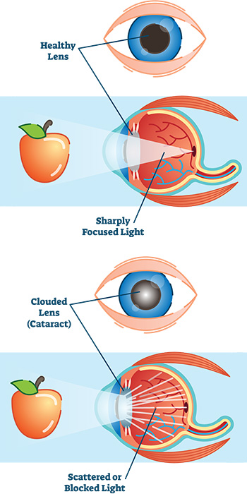 diagram with several eye drawings Healthy Lens Sharply Focused Light Clouded Lens (Cataract) Scattered or Blocked Light