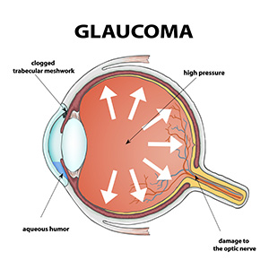 Glaucoma-Diagram